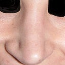 After first rhinoplasty, before revision.