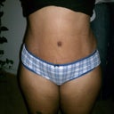 4 weeks. Just got stictches taken out of my belly button.