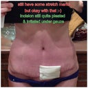 Exposing my stretch marks and incision to the world :-) I think it looks worse in the picture than real life and I have intrasite gel on the vertical so that explains the gauze