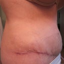 Right side view after drainage of hematoma.  Can't wait to see final results after all of the swelling subsides.