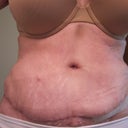 The day after my additional surgery to have the hematoma suctioned.