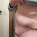 The night before surgery to suction the hematoma - this is just 2 days before the 4 week post-op mark.