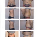 Left was taken on my pre-op for tummy tuck. Right are taken before my lipo surgery