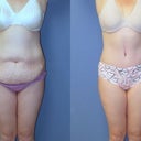 Front pic of before & 3 months after