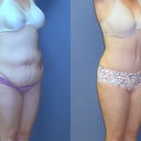Right side of before and at 3 monthsfter