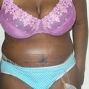 3wks post-op