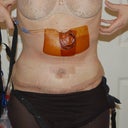 2 Days Post Op sill with Pain Pump and Drains