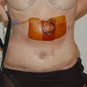 2 Days Post Op sill with Pain Pump and Drains