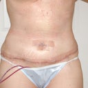 3 Days - removed pain pump!