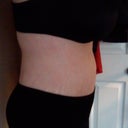 Side view 3 months post op.