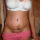 6th day after very swollen