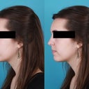 Before view left, computer imaging. My nose is crooked and more upturned on this side, so it would look different once straightened. Which is good, because I'm uncomfortable with this image and am requesting more clarification to make sure it match the right side closer.