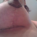 4 Weeks Post Op R Breast.  Notice very light scars.  Yay!!!