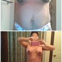 Comparing Front View Pre Op to 4 Weeks Post Op