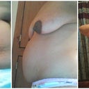 Comparing Side View from Pre Op May '12 before exercise to Pre Op Aug '12 after working out 3 months to 4 Weeks Post Op