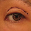 Left Eye (had double)