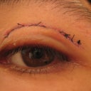 Left Eye (had double)