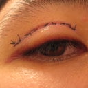 Right Eye (always single)