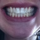 Without aligners