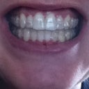 With aligners