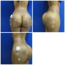 Wish Pic - Actual Patient results from Dr. Jimerson
