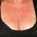 I wanted to update my picture. I had the IPL done last week and this breakout occurred. This picture is several days of healing.