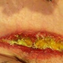 Here's the start of the incision opening up. I looked at it and freaked out. I was also afraid it was infected and it was not. The yellow stuff is what your body produces and has to be cleared away in order for the wound to heal. The wet to dry method removes the yellow and brings on the red, meaty look which is when it will start to heal from the inside out and from the sides inward.