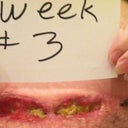 After 3 weeks. Now you can see the wound is coming together. Slowly but surely. I stopped fearing it would keep spreading at this point.