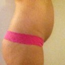 BEFORE surgery (side view) April 11,2012