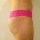 After surgery (side view) May 1,2012