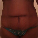 Pre-surgery front