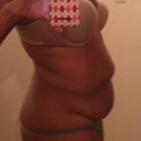 Pre-surgery left side
