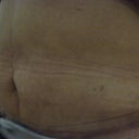 After the procedure
