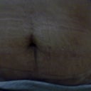 After the procedure