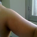before upper arm liposuction