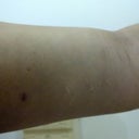 after procedure.  It looks like its a little more saggy than it originallt was.  Should I wait longer for final results?