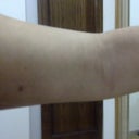 after procedure.  It looks like its a little more saggy than it originallt was.