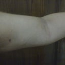 after procedure.  It looks like its a little more saggy than it originallt was.