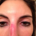 2 weeks after accident...looking a lot better