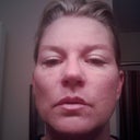 Noticeable drooping to left right side of face.
