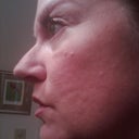 Puffy and swollen with burns