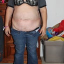 Before tummy tuck