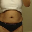 Pre-Surgery Pic 1 - Hiding the hang.