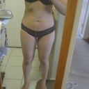 From the front - day 1 post op