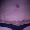 16 weeks close up of scar and belly button.