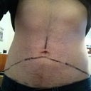 Pre Op - Mark ups, the incision will either be below or above the belly button, to be determined during surgery.