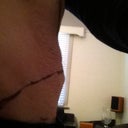 Pre Op - Mark ups, side view.