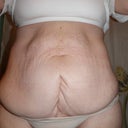 tummy after 4 c-sections