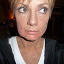 My face 6 days after RADIESSE
