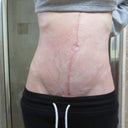 6 weeks post op